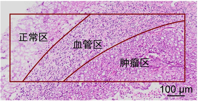 病理区域圈选示例